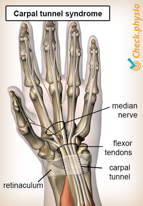 hand carpal tunnel syndrome carpal impingement