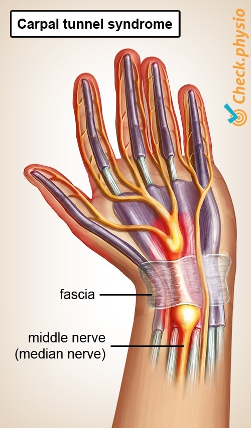 Carpal tunnel syndrome