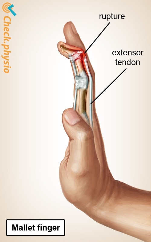 hand mallet finger