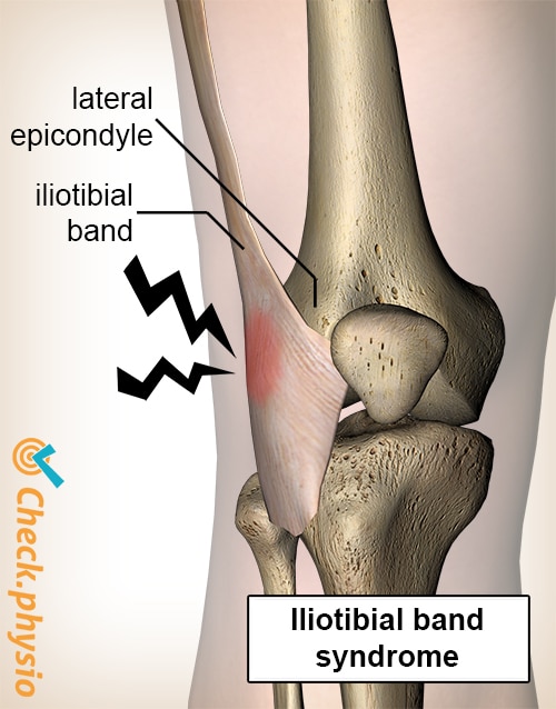 afbeelding_alt_knie-iliotibiaal-band-syndroom-laterale-epicondyl