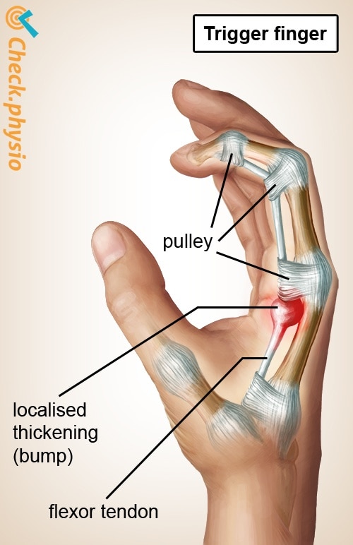 Trigger Finger or Trigger Thumb: Otherwise Known as Stenosing