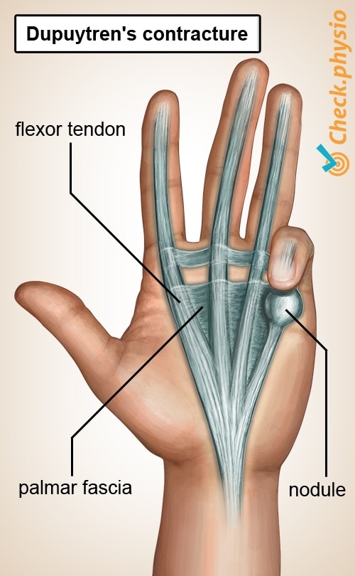 hand Dupuytrens disease aponeurosis palmaris nodule