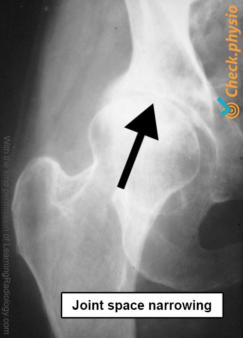 hip osteoarthritis x-ray joint line