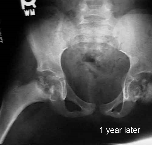 hip legg calve perthes age 7