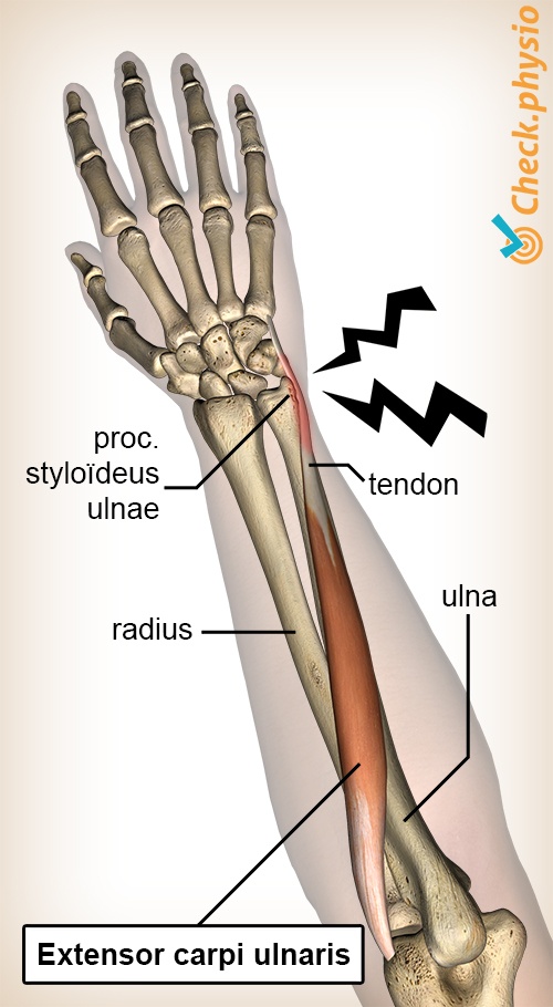 Styloid Process Of Radius Pain