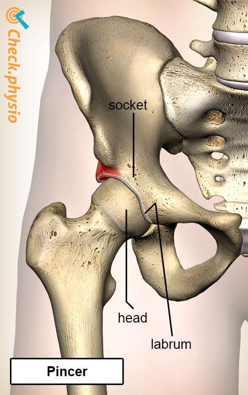 hip femoroacetabular impingement fai pincer