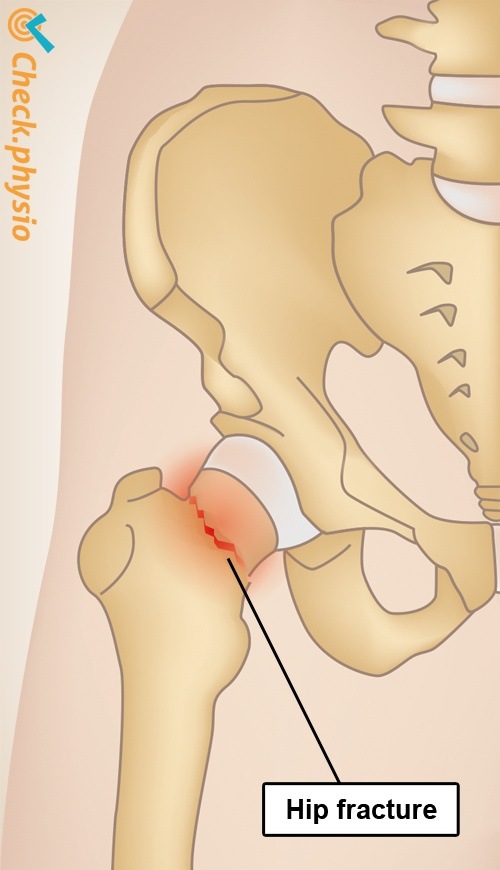 hip fracture anatomy