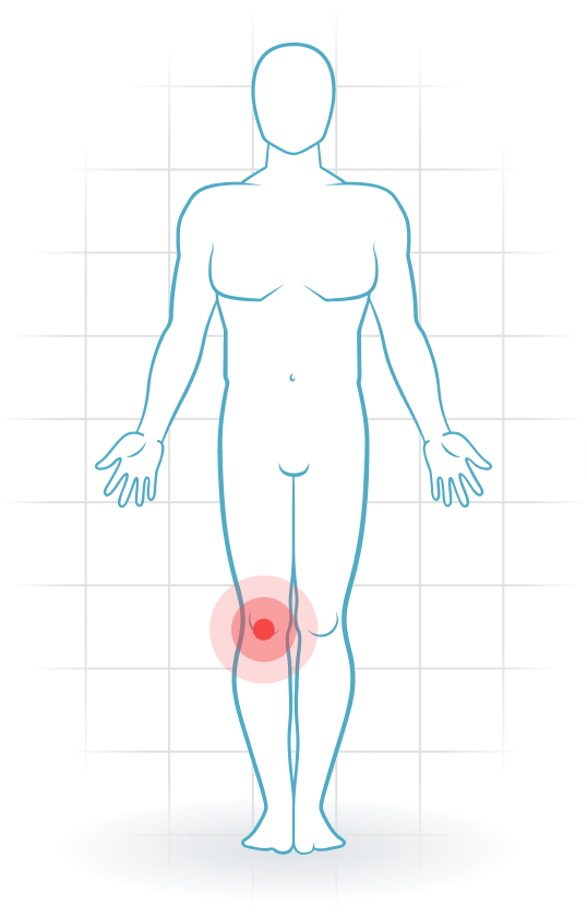 pijnlocatie Patellofemoral pain syndrome