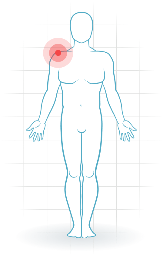 pijnlocatie Acromioclavicular injury