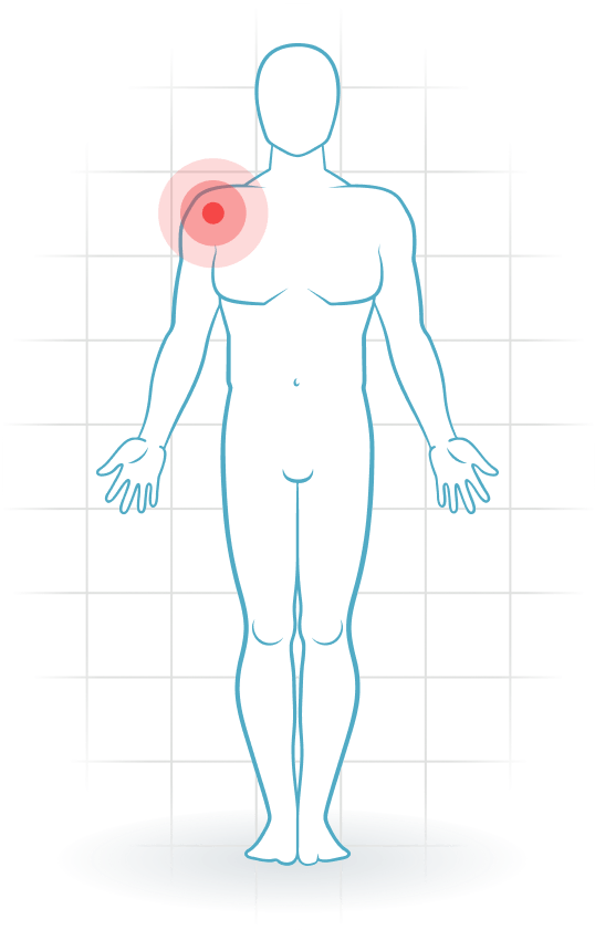 pijnlocatie Osteoarthritis of the shoulder