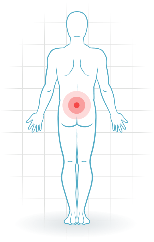 pijnlocatie Nonspecific lower back pain