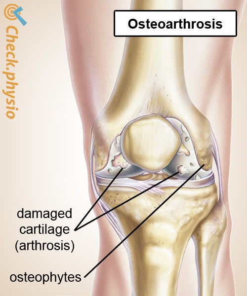 knee osteoarthritis cartilage degeneration