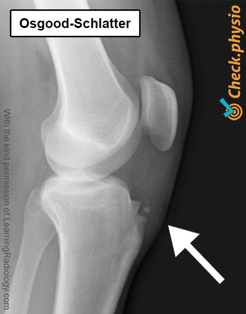 knee osgood schlatter x-ray