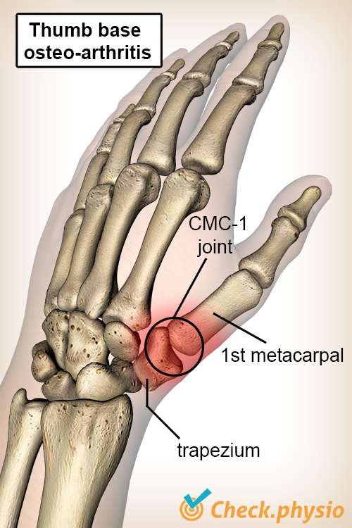 hand thumb base osteoarthritis os trapezium bone metacarpal I CMC 1 joint