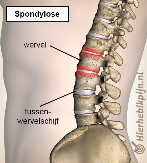 Rug spondylose spondylosis wervelkolom wervel tussenwervelschijf wervel discus slijtage artrose